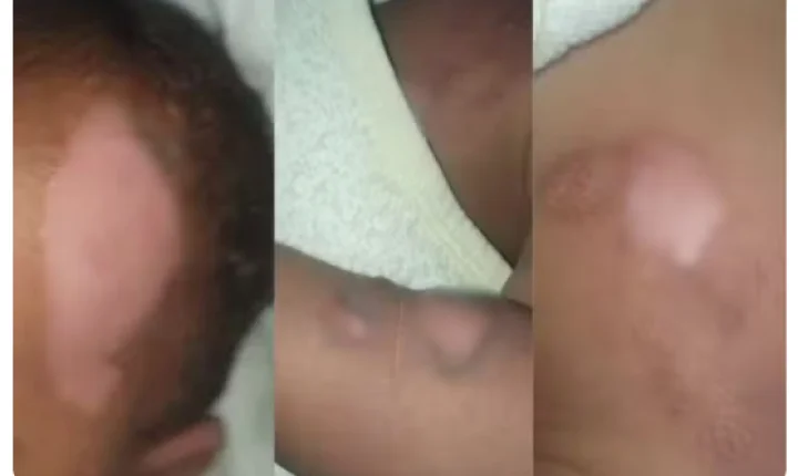 BEBÊ É INTERNADO EM ESTADO GRAVE APÓS SOFRER QUEIMADURAS EM CRECHE NO PARANÁ