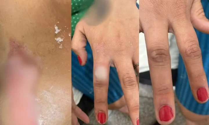 HOMEM É PRESO SUSPEITO DE ATEAR FOGO NA COMPANHEIRA APÓS DISCUSSÃO NO NORTE DO PARANÁ